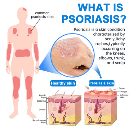 ✅ Official Store: Zvoevo® Magnesium Herbal Psoriasis Spray⚕️FDA Certified (Relieves psoriasis, eczema, and seborrheic dermatitis; treats acne; improves bacterial infections in intimate areas)