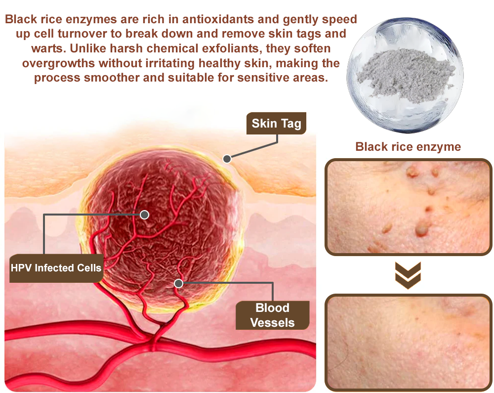Zvoevo® Black Rice Essence Cream⚕️FDA Certified (Removes warts and skin growths, improves seborrheic keratosis, skin cancer, and hidradenitis suppurativa, treats purpura and eczema)