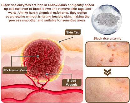 Zvoevo® Black Rice Essence Cream⚕️FDA Certified (Removes warts and skin growths, improves seborrheic keratosis, skin cancer, and hidradenitis suppurativa, treats purpura and eczema)