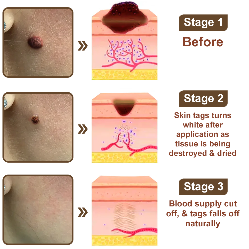 Zvoevo® Black Rice Essence Cream⚕️FDA Certified (Removes warts and skin growths, improves seborrheic keratosis, skin cancer, and hidradenitis suppurativa, treats purpura and eczema)