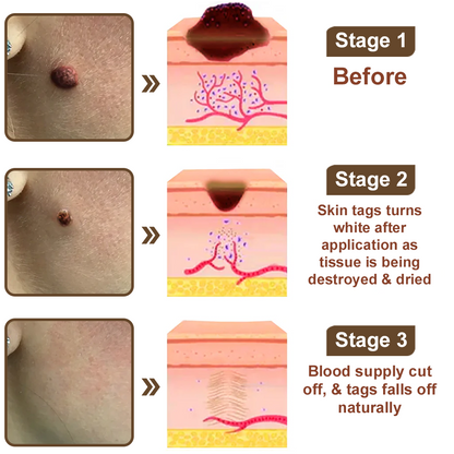 Zvoevo® Black Rice Essence Cream⚕️FDA Certified (Removes warts and skin growths, improves seborrheic keratosis, skin cancer, and hidradenitis suppurativa, treats purpura and eczema)