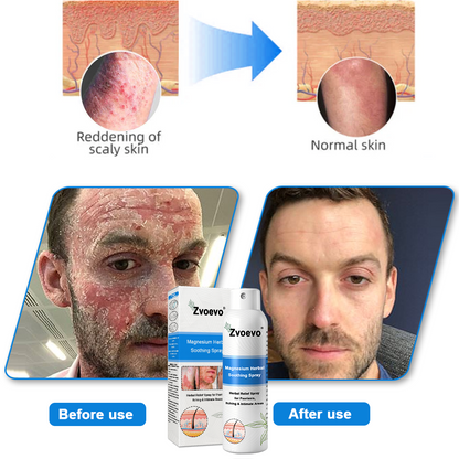 ✅ Official Store: Zvoevo® Magnesium Herbal Psoriasis Spray⚕️FDA Certified (Relieves psoriasis, eczema, and seborrheic dermatitis; treats acne; improves bacterial infections in intimate areas)