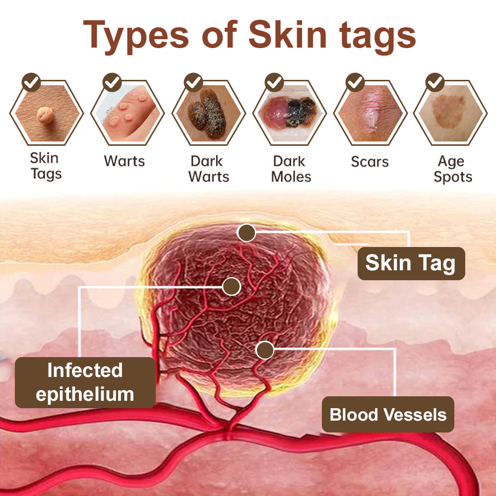 Zvoevo® Black Rice Essence Cream⚕️FDA Certified (Removes warts and skin growths, improves seborrheic keratosis, skin cancer, and hidradenitis suppurativa, treats purpura and eczema)