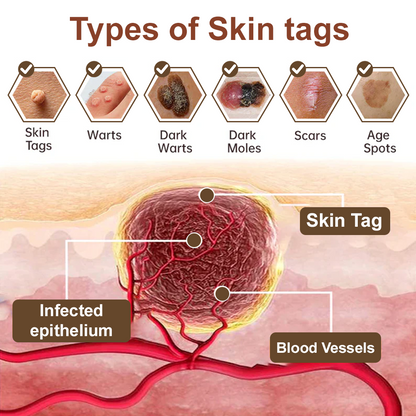 Zvoevo® Black Rice Essence Cream⚕️FDA Certified (Removes warts and skin growths, improves seborrheic keratosis, skin cancer, and hidradenitis suppurativa, treats purpura and eczema)