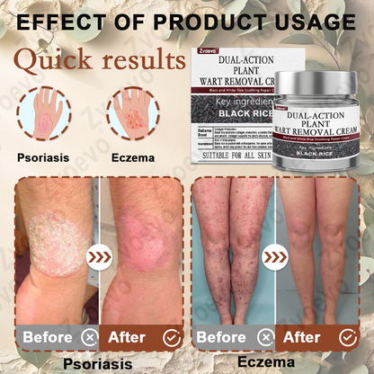 Zvoevo® Black Rice Essence Cream⚕️FDA Certified (Removes warts and skin growths, improves seborrheic keratosis, skin cancer, and hidradenitis suppurativa, treats purpura and eczema)