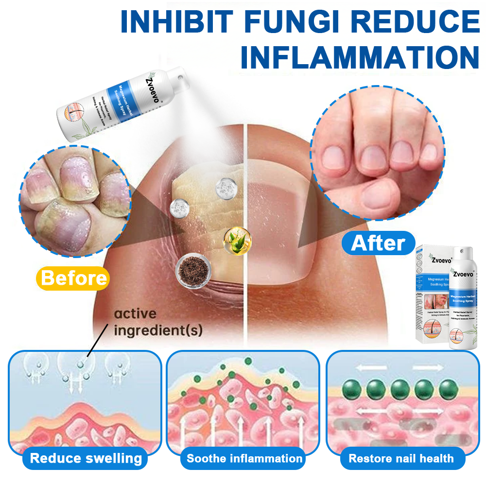 ✅ Official Store: Zvoevo® Magnesium Herbal Psoriasis Spray⚕️FDA Certified (Relieves psoriasis, eczema, and seborrheic dermatitis; treats acne; improves bacterial infections in intimate areas)