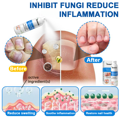 ✅ Official Store: Zvoevo® Magnesium Herbal Psoriasis Spray⚕️FDA Certified (Relieves psoriasis, eczema, and seborrheic dermatitis; treats acne; improves bacterial infections in intimate areas)